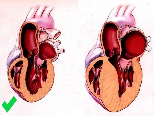 Cardione prévient l'hypertrophie ventriculaire du cœur